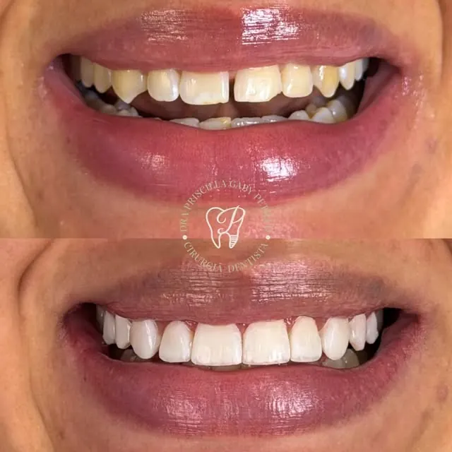 Sorriso antes e depois de facetas, publicado pela Clínica Hera